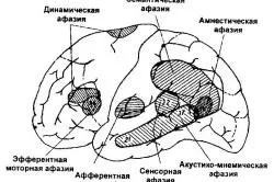 Відновлення промові після інсульту вправи, лікування (інсульту) Відновлення промові після інсульту вправи, лікування