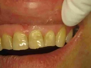 Відновлення зубної емалі лікування при тертя та руйнуванні (стіраємості) Відновлення зубної емалі лікування при тертя та руйнуванні