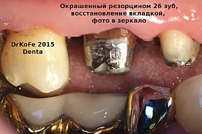 Отрута чи ліки, застосування формальдегіду в ендодонтії (russian red) Отрута чи ліки, застосування формальдегіду в ендодонтії