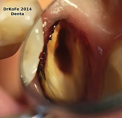 Отрута чи ліки, застосування формальдегіду в ендодонтії (основі резорцин-формалінової суміші) Отрута чи ліки, застосування формальдегіду в ендодонтії