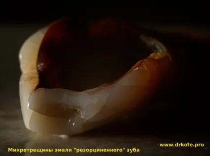 Отрута чи ліки, застосування формальдегіду в ендодонтії (застосування) Отрута чи ліки, застосування формальдегіду в ендодонтії