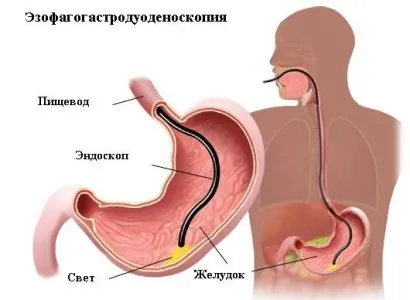 За скільки годин можна їсти перед ФГДС і чи можна пити воду (годин) За скільки годин можна їсти перед ФГДС і чи можна пити воду