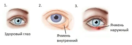 Заразний чи ячмінь на оці чи ні і як він передається (оці) Заразний чи ячмінь на оці чи ні і як він передається
