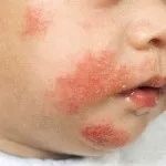 Лікування позбавляючи у домашніх умовах - симптоми і фото (умовах) Лікування позбавляючи у домашніх умовах - симптоми і фото