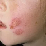 Лікування позбавляючи у домашніх умовах - симптоми і фото (домашніх) Лікування позбавляючи у домашніх умовах - симптоми і фото