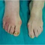 Лікування діабетичної стопи препарати і мазь, народні засоби при тріщинах на п'яті (препарати) Лікування діабетичної стопи препарати і мазь, народні засоби при тріщинах на п'яті