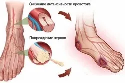 Лікування діабетичної стопи препаратами (стопи) Лікування діабетичної стопи препаратами