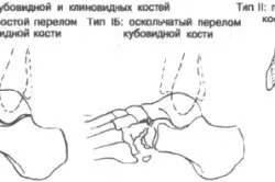 Лікування перелому стопи ноги (ноги) Лікування перелому стопи ноги