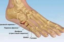 Лікування перелому стопи ноги (стопи) Лікування перелому стопи ноги