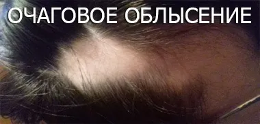 Лікування облисіння, лікування алопеції - центр лікування волосся, алопеція ареата, облисіння (алопеція ареата) Лікування облисіння, лікування алопеції - центр лікування волосся, алопеція ареата, облисіння