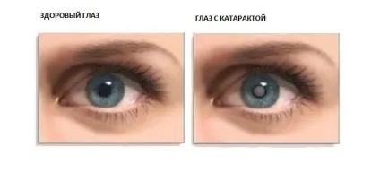 Лікування катаракти народними засобами і лікарськими препаратами, як проводиться операція по (операція з видалення катаракти) Лікування катаракти народними засобами і лікарськими препаратами, як проводиться операція по