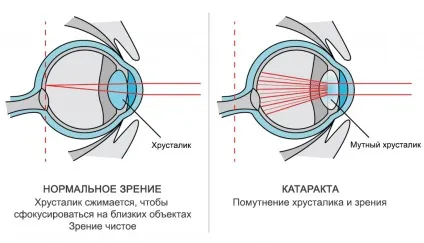 Лікування катаракти в москві (москві) Лікування катаракти в москві