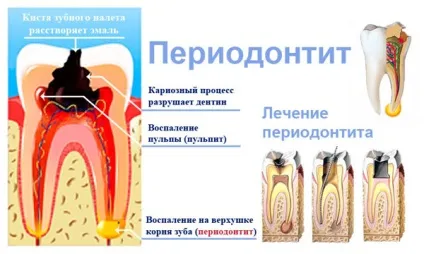 Лікування періодонтиту в Житомирі - лікування зуба, каналів, клініка (періодонтиту) Лікування періодонтиту в Житомирі - лікування зуба, каналів, клініка