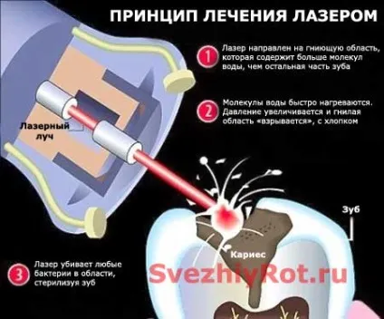 Лікування карієсу без свердління зубів і бормашини (фото і відео) (лікування) Лікування карієсу без свердління зубів і бормашини (фото і відео)