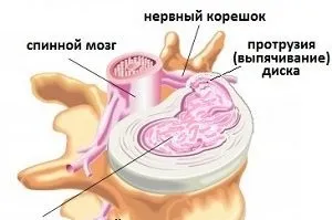 5 Методів використовуваних при лікуванні протрузії міжхребцевих дисків (дисків) 5 Методів використовуваних при лікуванні протрузії міжхребцевих дисків
