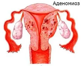 Аденоміоз матки що це таке