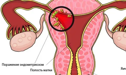 Аденоміоз матки що це таке