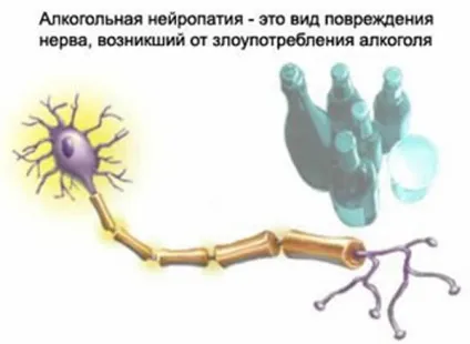 Алкогольна нейропатія (полінейропатія) - причини, симптоми, лікування, нижніх кінцівок,