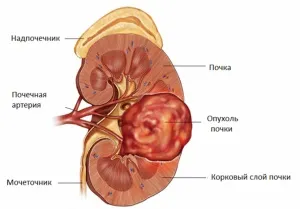 ангіоміоліпома нирки