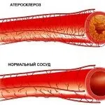 Атеросклероз черевної аорти причини, симптоми, діагностика, лікування, наслідки