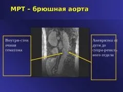 Атеросклероз черевного відділу аорти, симптоми, діагностика, лікування (черевного) Атеросклероз черевного відділу аорти, симптоми, діагностика, лікування