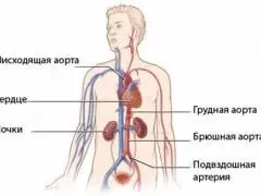 Атеросклероз черевного відділу аорти, симптоми, діагностика, лікування (черевного) Атеросклероз черевного відділу аорти, симптоми, діагностика, лікування