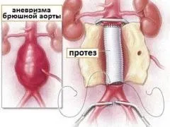 Атеросклероз черевного відділу аорти, симптоми, діагностика, лікування (черевного) Атеросклероз черевного відділу аорти, симптоми, діагностика, лікування