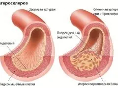 Атеросклероз черевного відділу аорти, симптоми, діагностика, лікування (відділу) Атеросклероз черевного відділу аорти, симптоми, діагностика, лікування