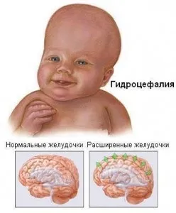 Асиметрична гідроцефалія і її симптоми