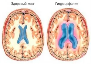 Асиметрична гідроцефалія і її симптоми