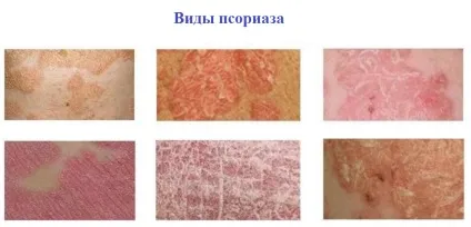 Артропатіческій псоріаз опис, способи лікування (артропатичний) Артропатіческій псоріаз опис, способи лікування