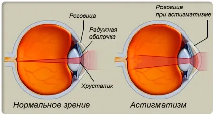 Астигматизм у дітей симптоми і причини