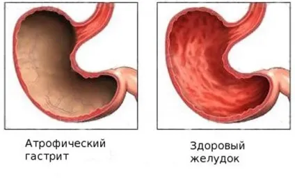 Атрофія слизової шлунка як лікувати і відновлювати (атрофія) Атрофія слизової шлунка як лікувати і відновлювати