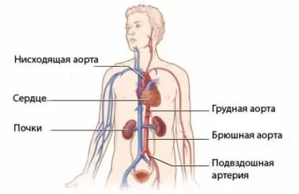 Атеросклероз черевного відділу аорти, симптоми, діагностика, лікування (відділу) Атеросклероз черевного відділу аорти, симптоми, діагностика, лікування