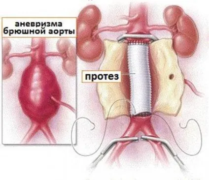 Атеросклероз черевного відділу аорти, симптоми, діагностика, лікування (атеросклероз) Атеросклероз черевного відділу аорти, симптоми, діагностика, лікування