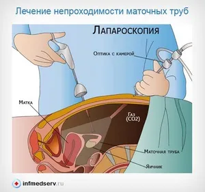 Вагітність при непрохідності маткових труб - вагітність і пологи - каталог статей - жіноче