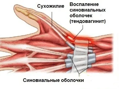 Хвороба де Кервена симптоми і лікування (хвороба де Кервена палець біль запалення сухожилля лікування симптом рух) Хвороба де Кервена симптоми і лікування