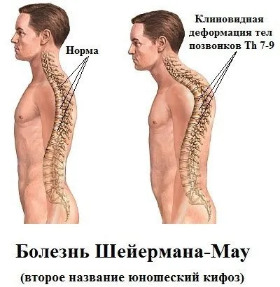 Хвороба (синдром) Шейермана-мау у дорослих і дітей симптоми, лікування, вправи, лікувальна (Шейермана-мау) Хвороба (синдром) Шейермана-мау у дорослих і дітей симптоми, лікування, вправи, лікувальна