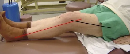 Болі після ендопротезування колінного суглоба, це нормально (болі) Болі після ендопротезування колінного суглоба, це нормально