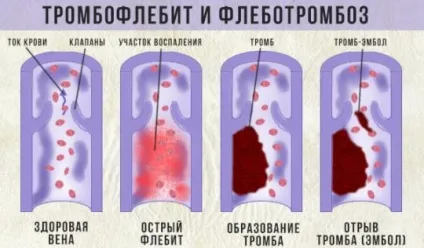 Хвороби судин ніг 8 симптомів які змушують бити на сполох (судин) Хвороби судин ніг 8 симптомів які змушують бити на сполох