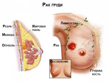 Біль у правій грудині у жінок причини, симптоми і можливі захворювання (симптоми) Біль у правій грудині у жінок причини, симптоми і можливі захворювання