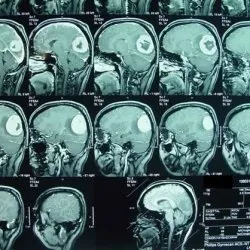 Аденоми гіпофіза клініка, діагностика, лікування - скальпель - медичний (клініка) Аденоми гіпофіза клініка, діагностика, лікування - скальпель - медичний