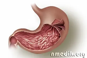 Чага при лікуванні хвороб травної системи (системи) Чага при лікуванні хвороб травної системи