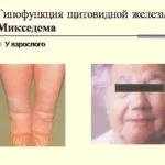 Чим небезпечний гіпотиреоз щитовидної залози (небезпечний) Чим небезпечний гіпотиреоз щитовидної залози
