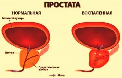Чай від простатиту зелений, урологічний збір, фіточай - склад і рекомендації щодо застосування для (чай від простатиту) Чай від простатиту зелений, урологічний збір, фіточай - склад і рекомендації щодо застосування для