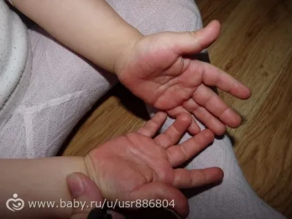 Чим ви мажете дитини при алергічних висипаннях