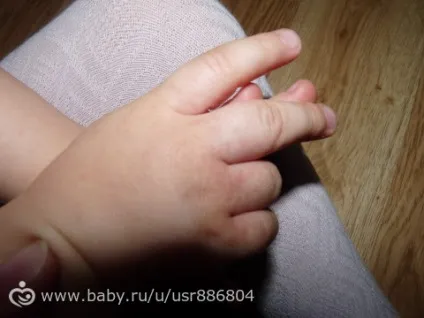 Чим ви мажете дитини при алергічних висипаннях