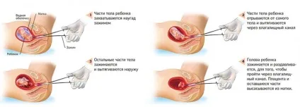 Частка після вагітності, що завмерла відновлення, виділення, місячні, болить живіт після процедури (вагітності) Частка після вагітності, що завмерла відновлення, виділення, місячні, болить живіт після процедури