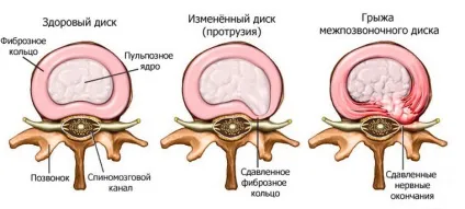 Що показує кт хребта
