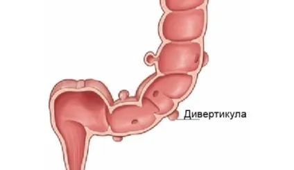 Дивертикулез лікування народними засобами в домашніх умовах (народними) Дивертикулез лікування народними засобами в домашніх умовах
